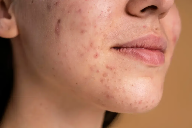 How to Get Rid of PIH (Post Inflammatory Hyperpigmentation)